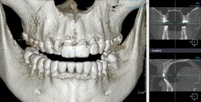 Результаты компьютерной томографии зубов